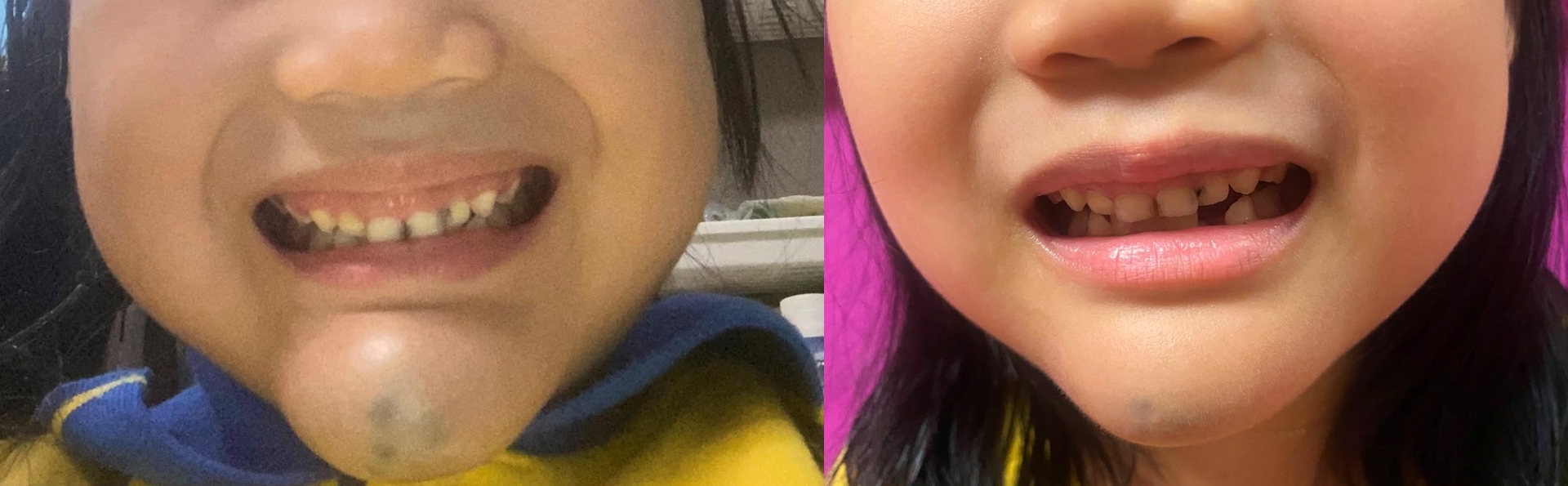 Following the treatment (right), the lesion on Yan-yan's chin shrunk significantly.