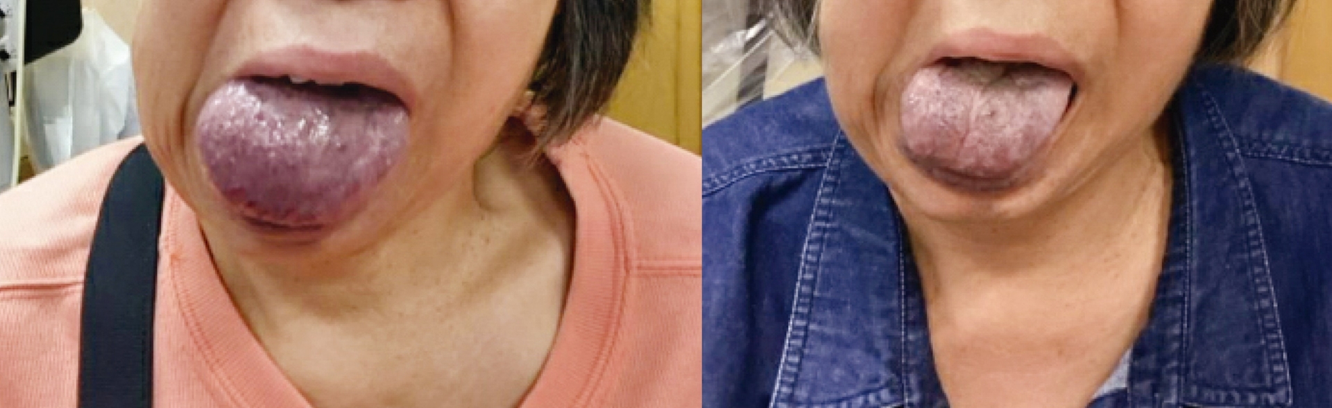 An adult patient suffered from a lesion on the tongue that caused difficulties in speech and swallowing. After receiving the new treatment, the tongue shrunk significantly, greatly improving daily life.