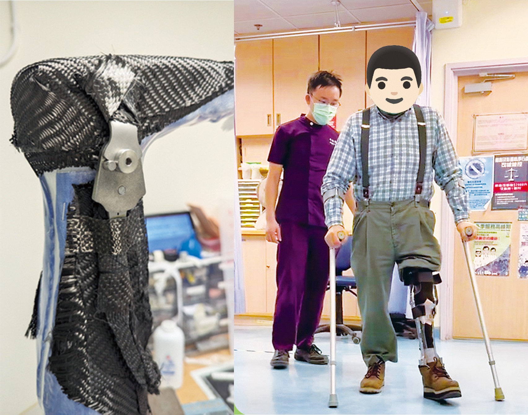 (Left) The carbon fibre cloth forms a smooth, strong CF e-mag active calliper after being layered and vacuum pressurised. (Right) The patient shares that learning and adjusting to this takes time, but once adapted, it truly reduces the stress on his lower back and improves walking posture.